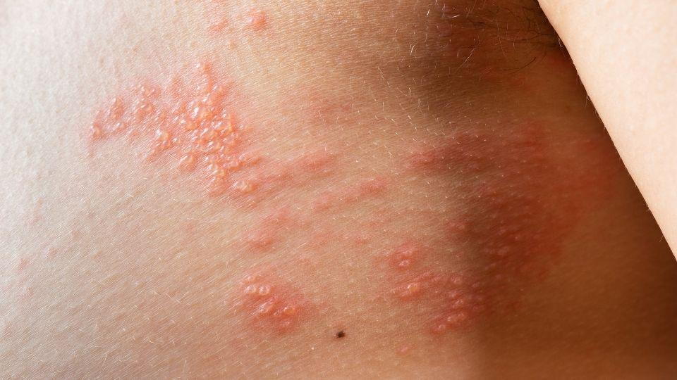 Shingles vs. Chickenpox: What's the Difference?