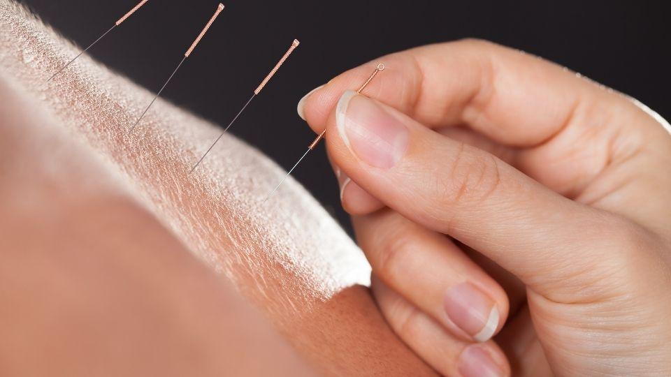 How to Know When Acupuncture is Working?