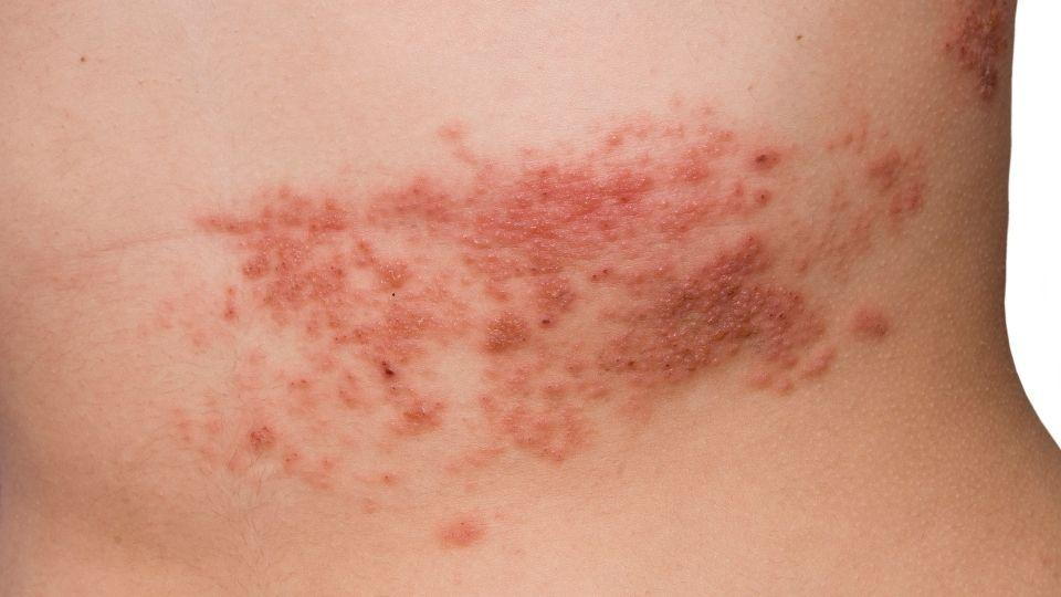 Shingles vs. Herpes: What's the Difference?