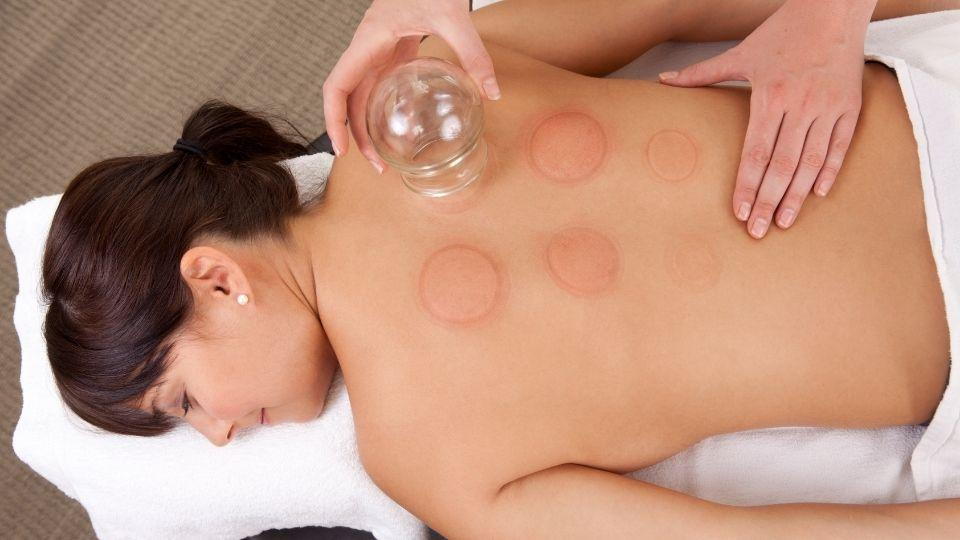 How Long Does It Take for Cupping Marks to Disappear?