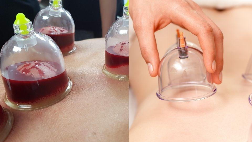 What is the Difference Between Dry and Wet Cupping?