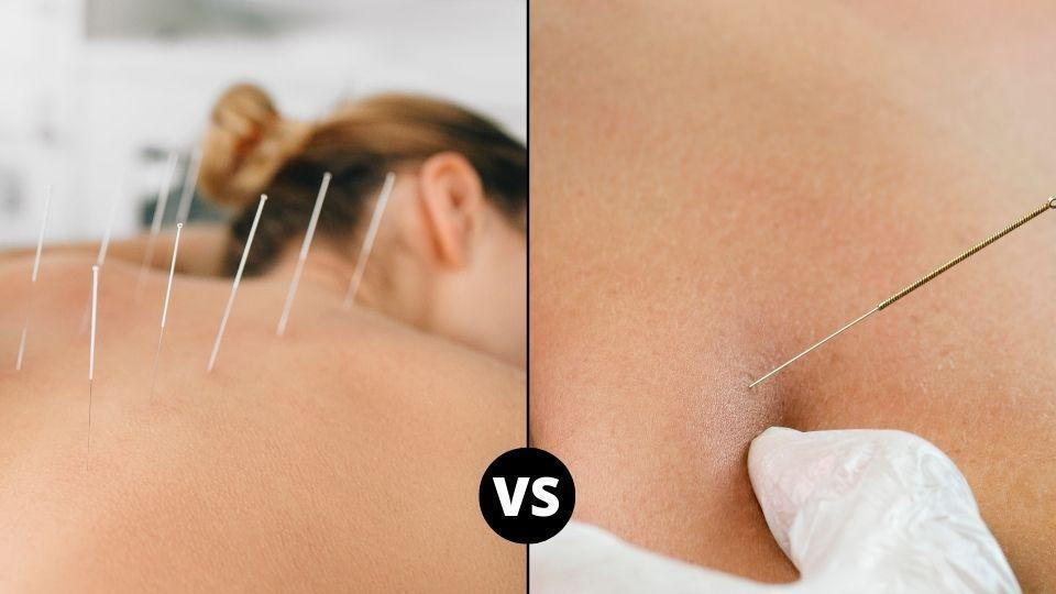 Acupuncture vs. Dry Needling: What's the Difference?