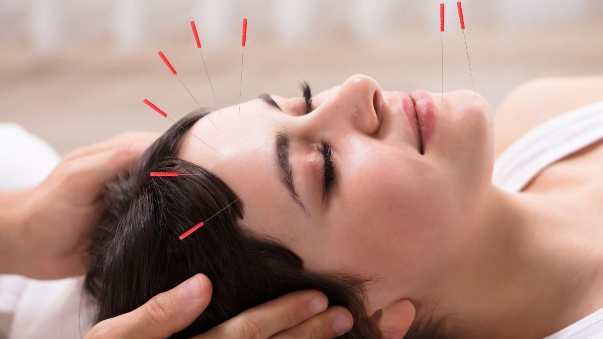 Acupuncture for Anxiety