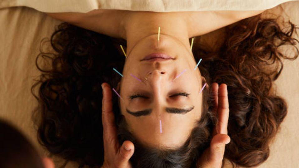 Women Undergoing Acupuncture Treatment On Her Face