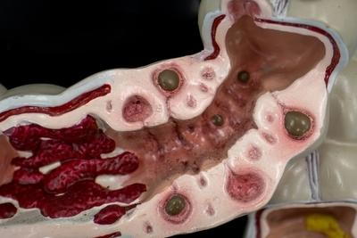Illustration of Diverticulitis in a model