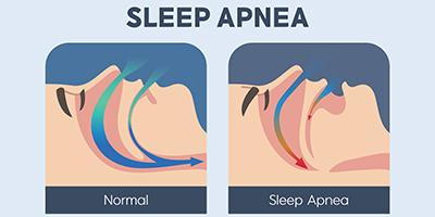 Medical illustration of airway blockage in sleep apnea