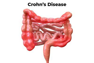 Visual model of digestive tract affected by Crohn’s disease, highlighting areas of chronic inflammation