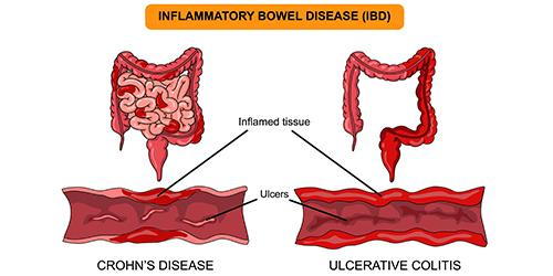 Comparison illustration of Crohn's disease and ulcerative colitis symptoms