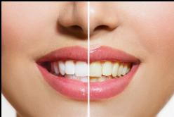 Teeth Whitening Worcester MA