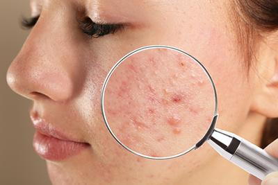 Female patient discussing acne concerns during a dermatology appointment.