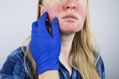 Female patient receiving a skin assessment for facial redness and rosacea symptoms.