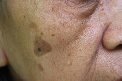 Skin discoloration and lentigo maligna caused by UV exposure