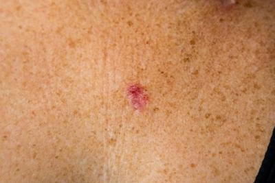 Illustration of Cell Carcinoma on skin of patient