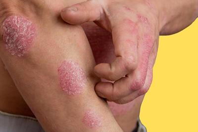 Man-with-Atopic-Dermatitis