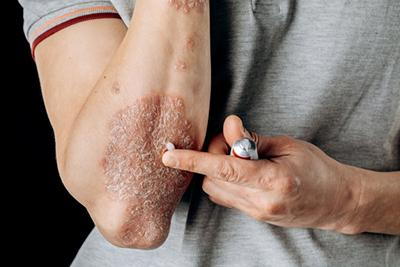 Man-putting-some-ointment-to-his-psoriasis-condition-with-gray-shirt