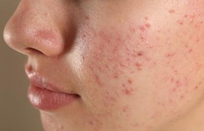 Woman with acne on her face with redness