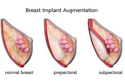 Patient preparing for reconstructive breast procedure