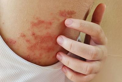 Woman-with-Severe-Atopic-Dermatitis