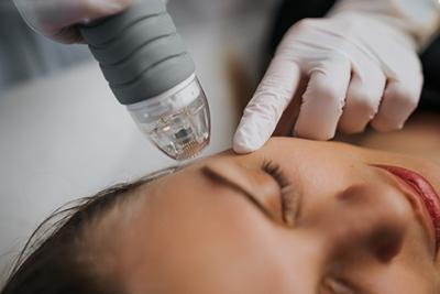 Womans face in Microneedling procedure with the doctor.