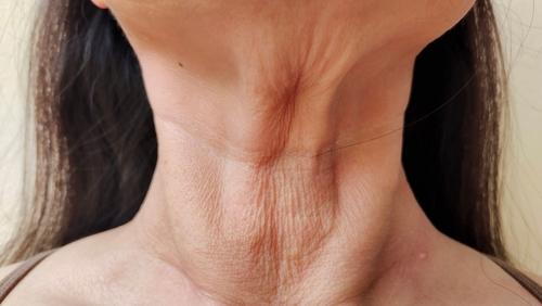 Close-up of a woman's neck showing sagging skin