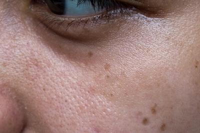 Illustration of Facial Brown Spots