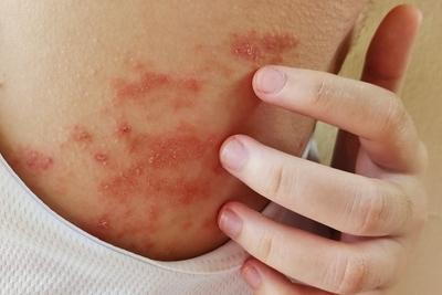 Person scrathching the eczema on skin