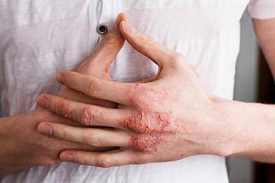 Person with Psoriasis in  hand.