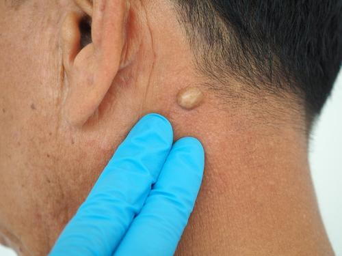 Dermatologist inspecting a patient's cyst prior to removal
