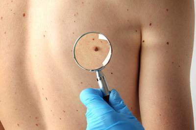 Skin moles in the back of patient with magnifying glass