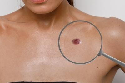 Illustration of melanoma on skin of a woman