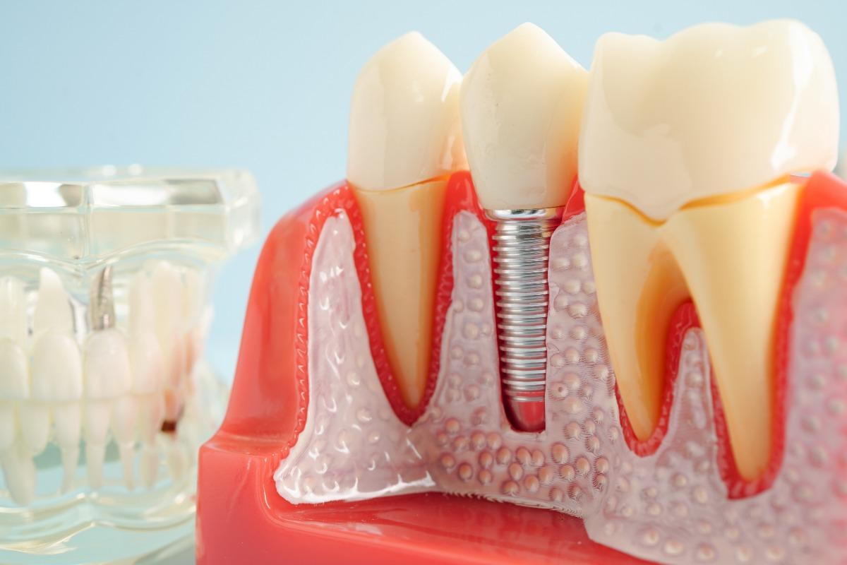 Painless Implant Surgery: What to Expect Before, During, and After the  Procedure