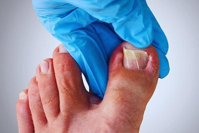 What You Need To Know About Ingrown Toenails