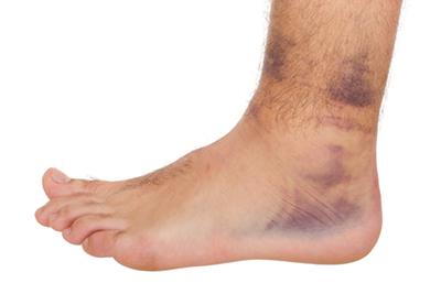 Young-Man-with-Sprained-Ankle
