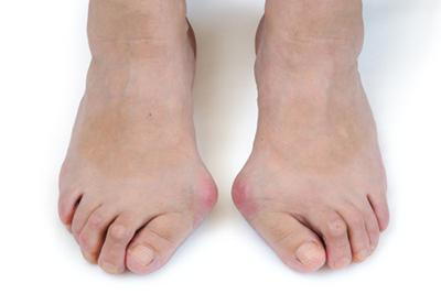 Illustration of bunions condition on persons foot