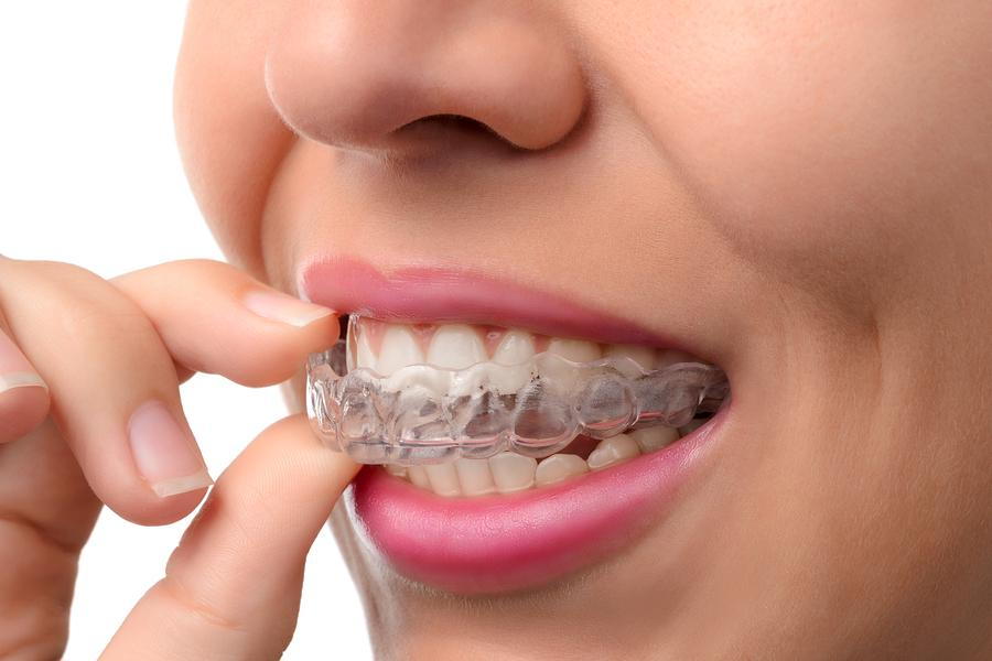Discover the Benefits of Invisalign