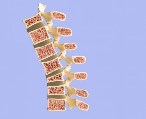 Spine affected by osteoporosis leading to poor posture