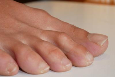 Illustration of hammertoes in person