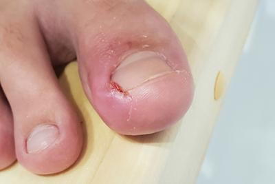 Closed-up-shot-of-Ingrown-Toenail-in-Foot.