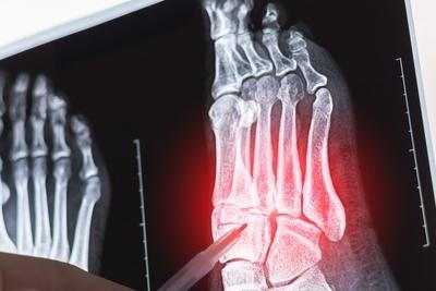 Illustration of Metatarsal Problems on xray