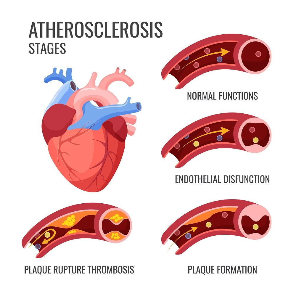 Cardiovascular Disease