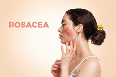 Woman-Touching-Her-Face-with-Rosacea