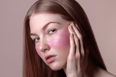 Woman-suffering-with-Rosacea-Condition