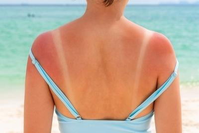 Skin burn on beach in the back of the woman.