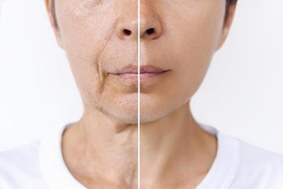 Before and after comparison of wrinkle removal