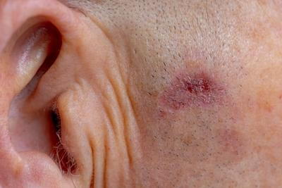 Skin lesion on a person skin