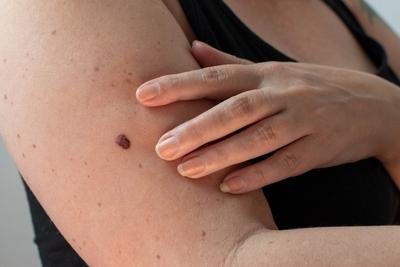 Hand-touching-arm-with-dark-mole