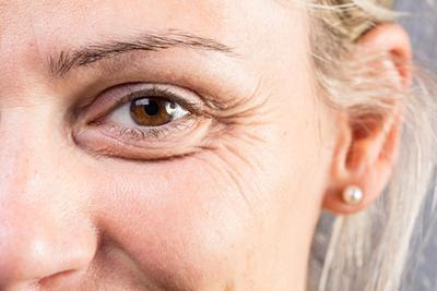Signs of aging near woman’s eyes with crow’s feet