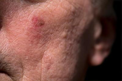 Facial skin of older man affected by actinic keratoses due to prolonged sun exposure