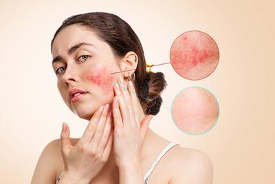 Rosacea-on-Women's-Face