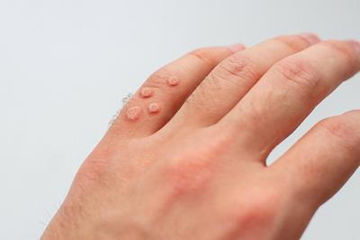Hands-with-Warts-Captured-in-a-Close-Up-View